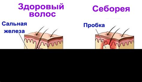 Жирная себорея: причины, симптомы (+фото) и лечение