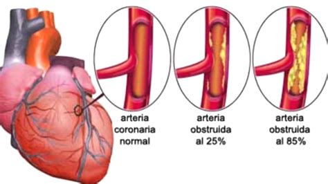 Infarto De Miocardio ¿qué Hacer Youtube