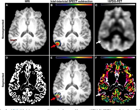 Figure 1 From Utility Of Gray Matter Segmentation Of Ictal Interictal