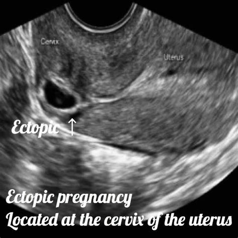 6 Weeks Ectopic Pregnancy Ultrasound