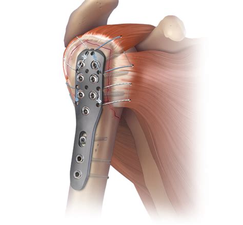 Arthrex Humeral SuturePlate