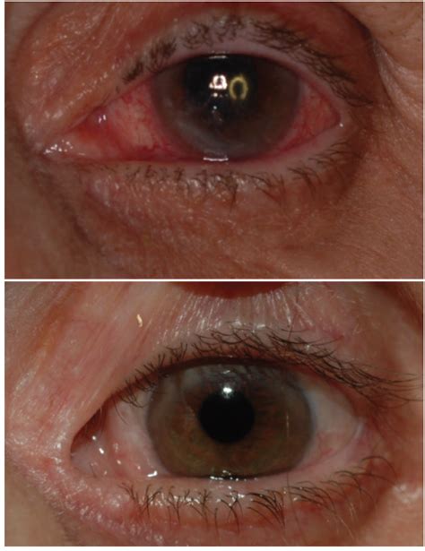 Neurotrophic Ulcer Cornea