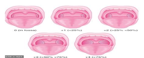 Figure 1 From Clinical Correlation Between Tonsillar Hypertrophy And