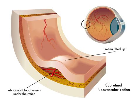 Wet Macular Degeneration: Symptoms, Treatment, and Research Updates