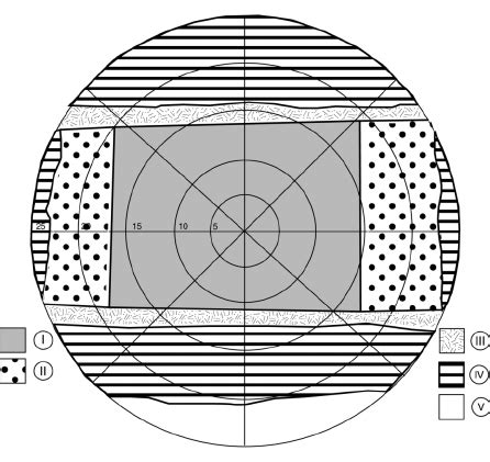 Binocular Visual Field With A Sony Glasstron Plm Wearer Measured