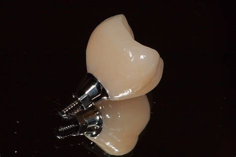 Screwed Retained Implant Crown From China Dental Lab China