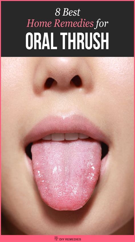 Home Remedies To Get Rid Of Oral Thrush