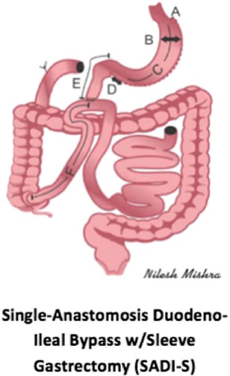 Single Anastomosis Duodenoileal Bypass With Sleeve Gastrectomy Sad I