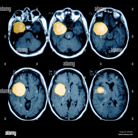 Tumeur Au Cerveau Photo Stock Alamy