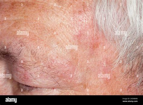 Shingles Close Up Of Blisters On The Forehead Of A 67 Year Old Male