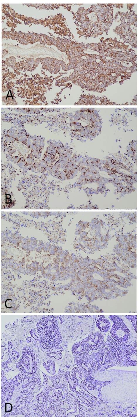 Immunohistochemical Analysis Of The Resected Pancreatic Tumor A