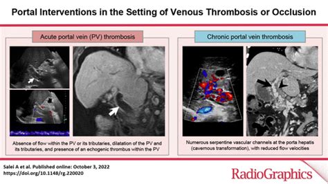 Portal Interventions In The Setting Of Venous Thrombosis Or Occlusion Radiographics