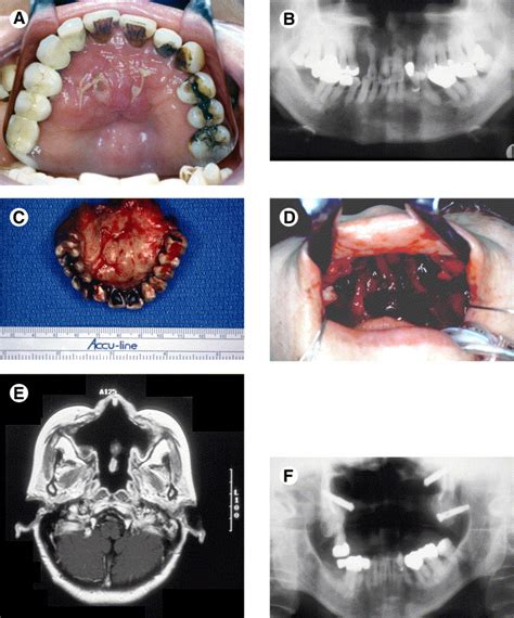 Reconstruction Of Extensive Maxillary Defects Using Zygomaticus