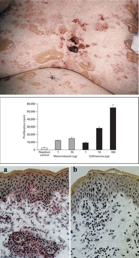 Figure From Drug Induced Linear Iga Bullous Dermatosis Associated