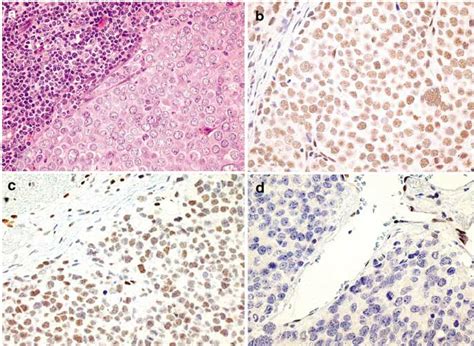 A Merkel Cell Carcinoma May Represent An Important Diagnostic