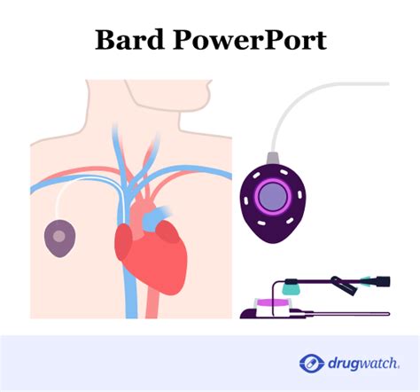 Bard PowerPort Complications: Types of Injuries & Complications