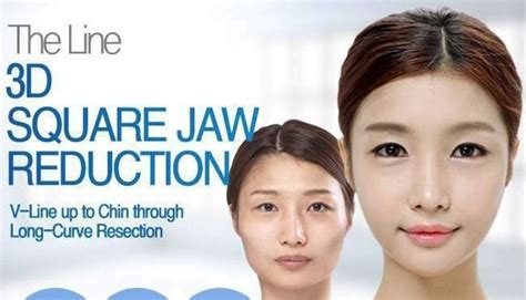 3D Square-Jaw (Mandibular) Angle Reduction