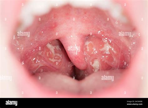 Tonsillitis Swollen And Pussy Tonsils Of An Year Old Female Patient