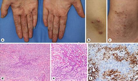 Figure 1 From Palisaded Neutrophilic And Granulomatous Dermatitis In A