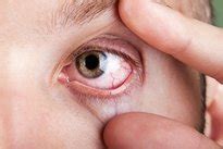 Coceira nos olhos 6 principais causas e o que fazer Tua Saúde