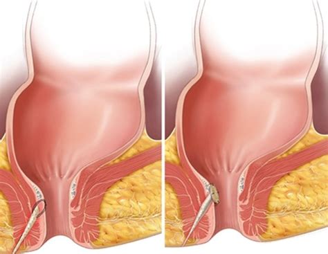 Fístula Anal O que é Causas e Tratamentos Dicas de Saúde