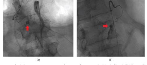 Figure From Hemosuccus Pancreaticus A Rare Bleeding Pseudoaneurysm