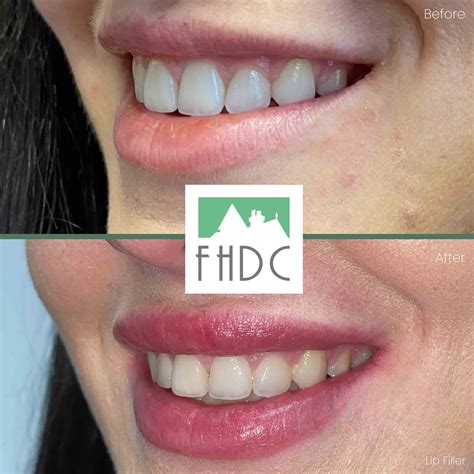 Facial Aesthetics Rejuvenation In Leeds Fhdc Leeds Dentists