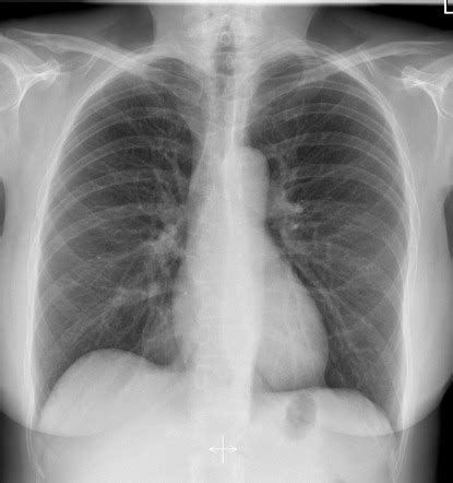 Chest Pa View Radiology Reference Article Radiopaedia Org