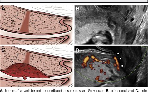 Figure 1 From The Clinical Outcome Of Cesarean Scar Pregnancies