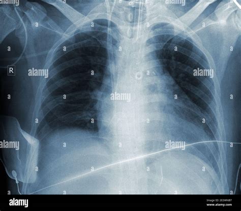 Radiografia Del Torace Immagini E Fotografie Stock Ad Alta Risoluzione