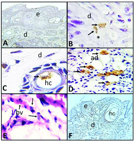 Photomicrographs Of Histologic Skin Sections With Carcinoma Caused By Download Scientific