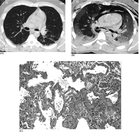 Serial Chest Ct Findings In Interstitial Lung Disease Associated With