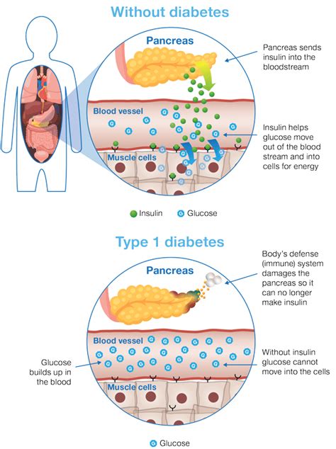 Exercise And Diabetes