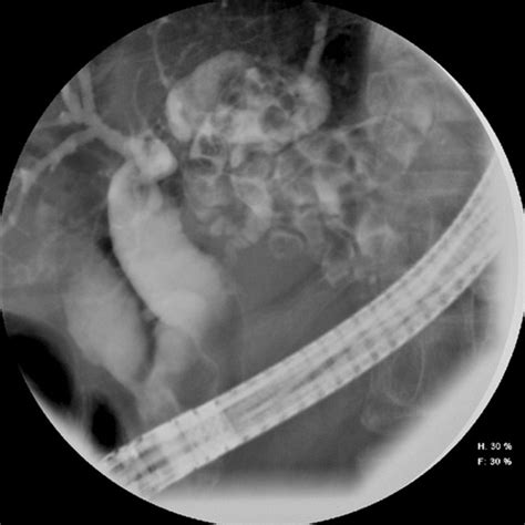 Cholangiogram Depicting A Large Amount Of Intrahepatic Duct Stones