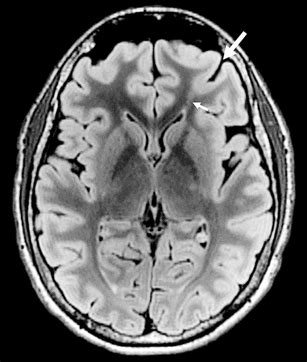 Focal Cortical Dysplasia Type Iib In A Year Old Girl Axial Flair Mr