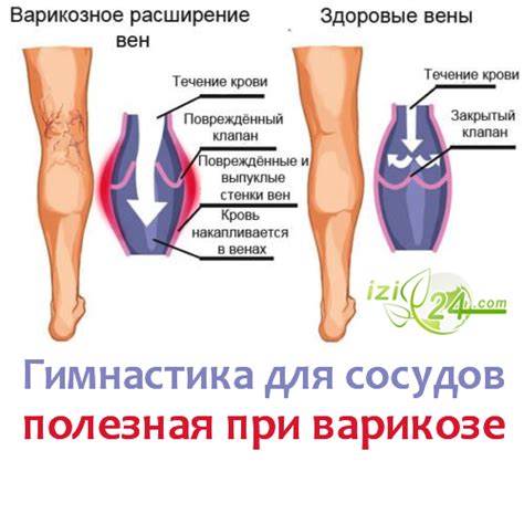 Гимнастика для сосудов: 15 упражнений, полезных при варикозе Варикозное ...