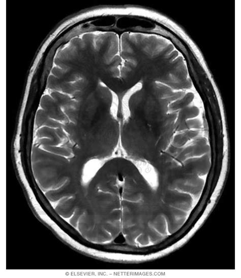 T2 Weighted Mri