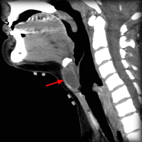 Thyroglossal Duct Cyst Causes Symptoms Diagnosis Treatment Surgery