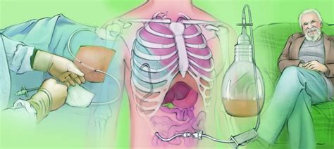 Catéter de drenaje tunelizado The Interventional Initiative