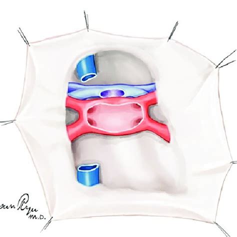 Kocherization With The Mobilization Of The Infrahepatic Inferior Vena