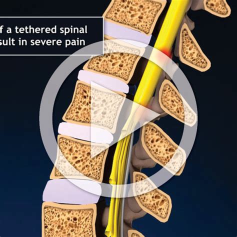 Tethered Cord Syndrome with Surgical Repair - TrialExhibits Inc.