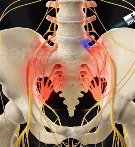 Transforaminal Epidural Steroid Injection Lumbar And Sacral Genesis