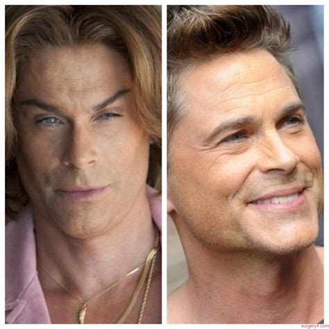 Rob Lowe Plastic Surgery Photos [before And After] Surgery4