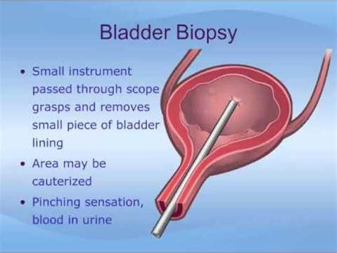 Cystoscopy - YouTube
