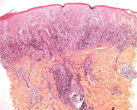 Hematoxylin Eosin Stained First Biopsy Specimen First Biopsy Dense