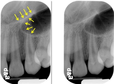 Y Line Of Ennis Radiographs Dr G S Toothpix