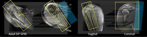 Hombro Resonancia Magn Tica Los Protocolos Y Su Pr Ctica Hot