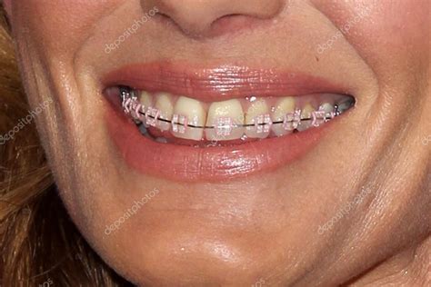 Faith Hill Braces