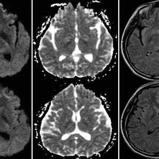 Follow Up Brain Magnetic Resonance Imaging Mri Obtained Days After