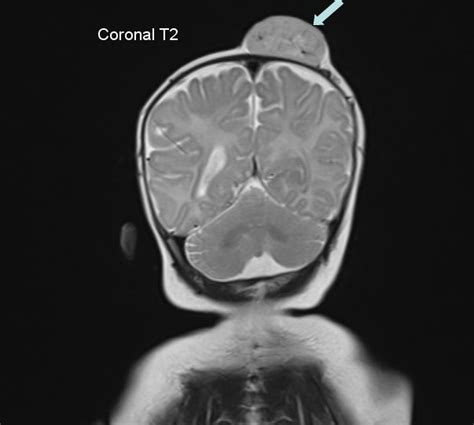 Mricases Infantile Scalp Hemangioma Mri Features